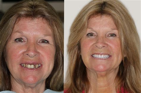 <b>Dentures</b> for holiday-ready smiles. . Affordable dentures refund policy